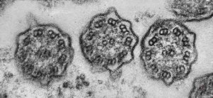 F,5y. | immotile cilia syndrome - nasal mucosa